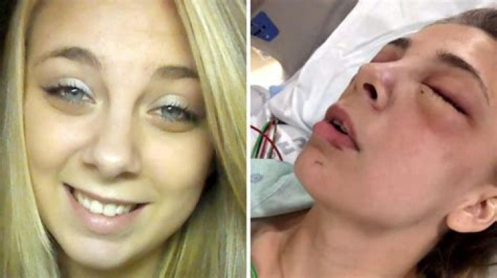 Girl Gouged Out Eyes