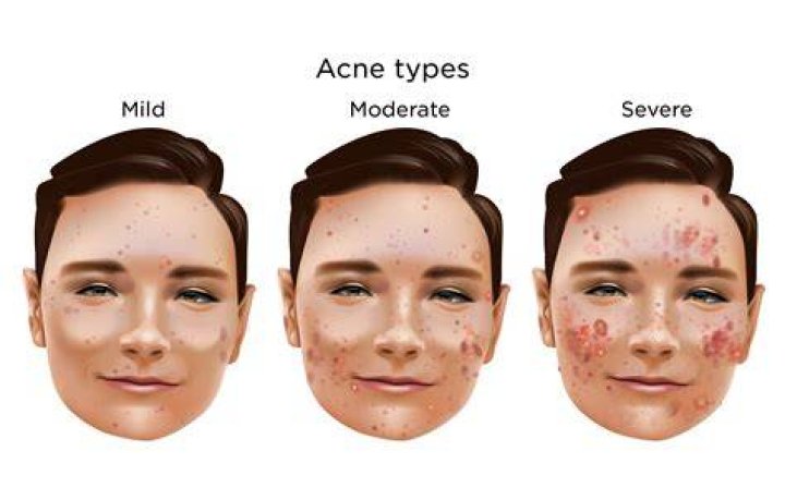 James Michael With Severe Acne