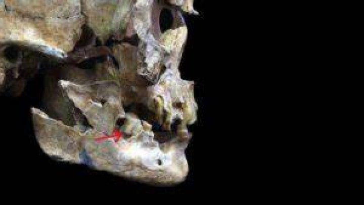 Jomon Woman Skull With Tooth