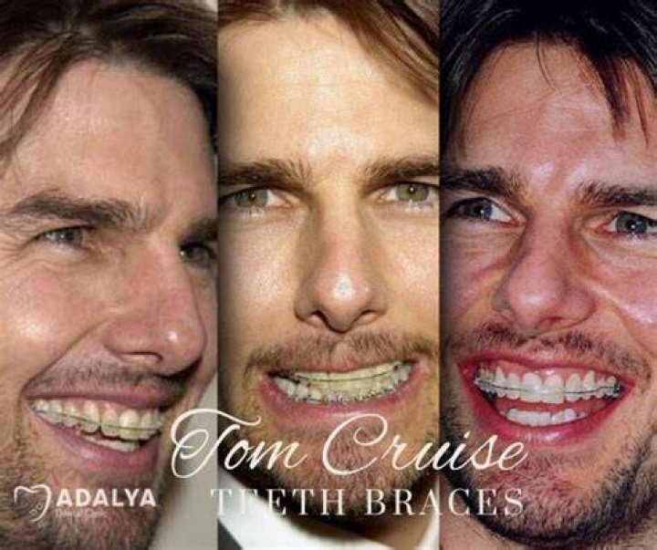 tom cruise braces tom cruise braces